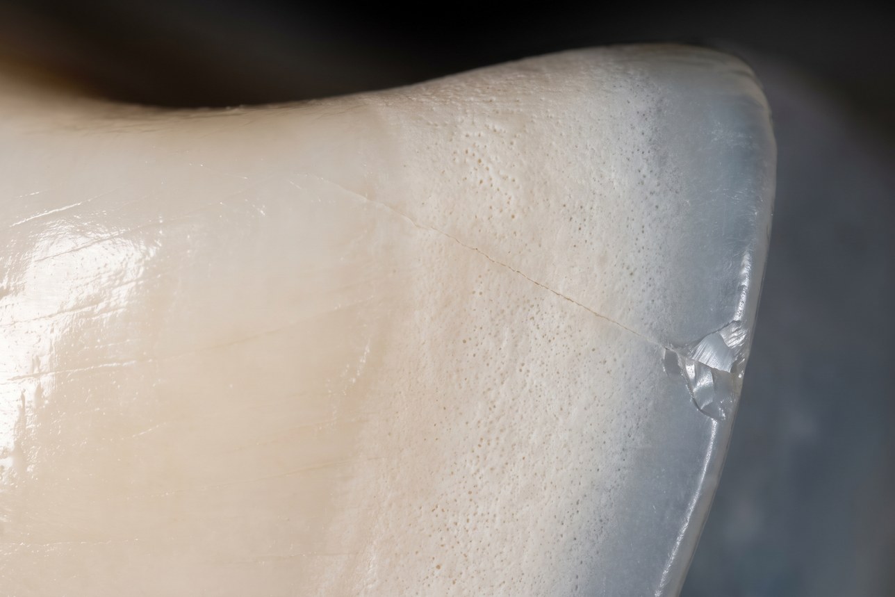Tooth enamel erosion: glossy sound enamel meeting a chalky etched zone under macro