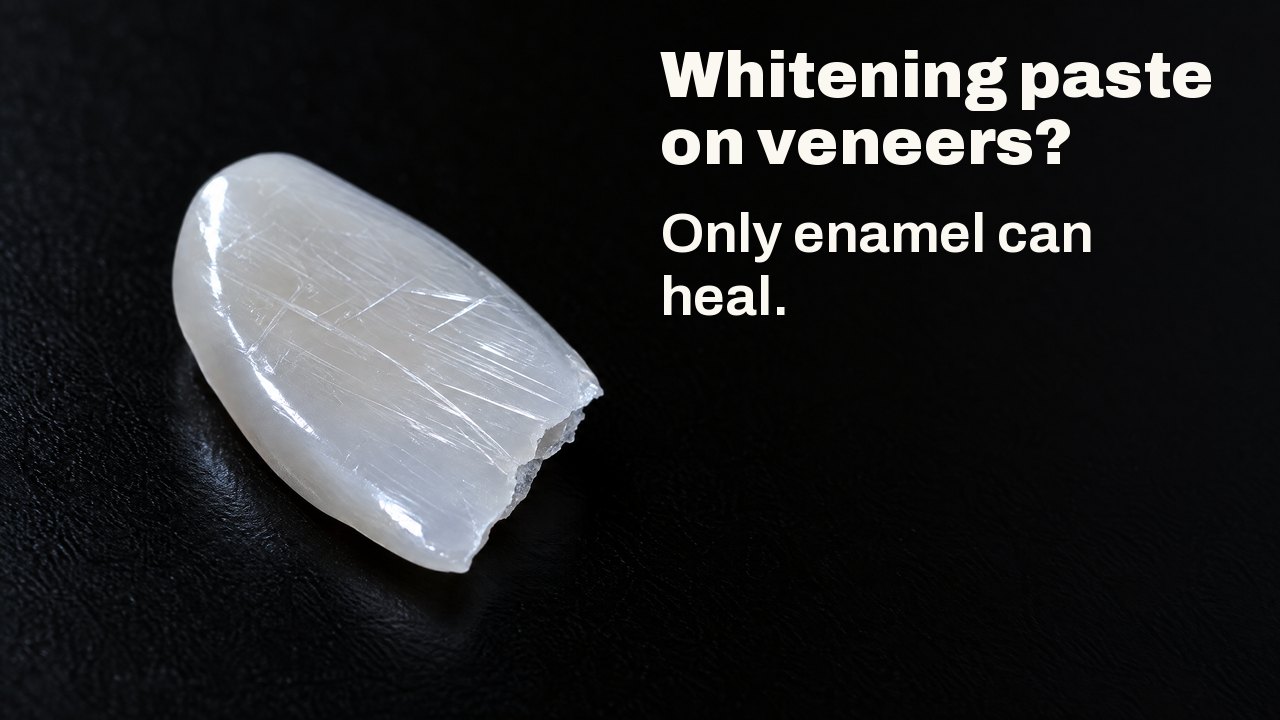 Whitening paste on veneers? Only enamel can heal. Under raking light: a thin glossy porcelain shard like a veneer, its surface crossed by fine scratches, on black.