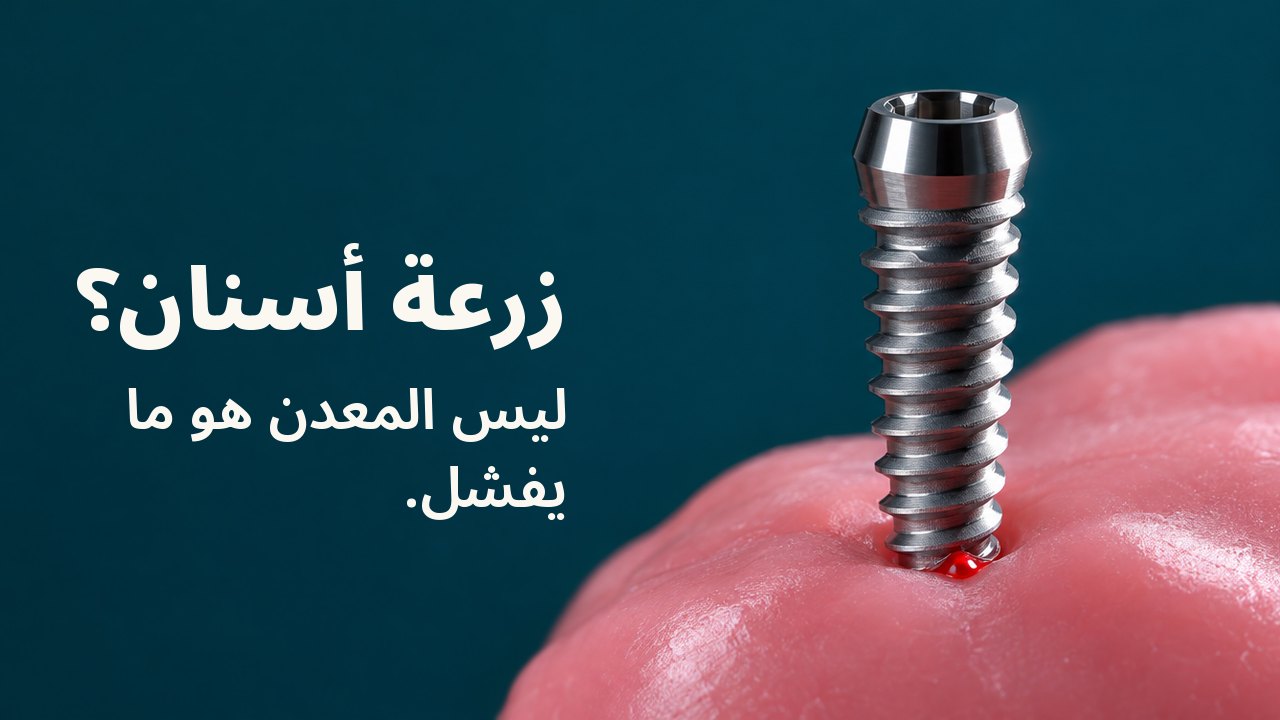 زرعة أسنان؟ ليس المعدن هو ما يفشل. برغي تيتانيوم مصقول منتصب في طبقة من الشمع الوردي الطري، مضاء بضوء حاد من جانب واحد على خلفية فيروزية داكنة.