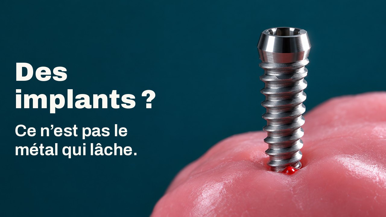 Des implants ? Ce n’est pas le métal qui lâche. Une vis en titane polie dressée dans un lit de cire rose souple, éclairée durement d’un côté sur un fond bleu canard profond.