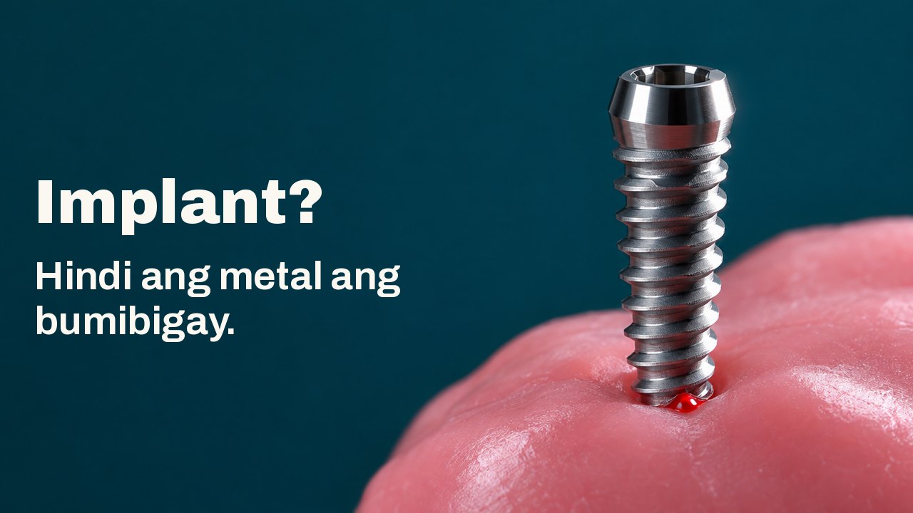Implant? Hindi ang metal ang bumibigay. Isang makintab na titanium screw na nakatayo sa malambot na pink na wax, may matapang na ilaw mula sa isang gilid at malalim na teal na background.